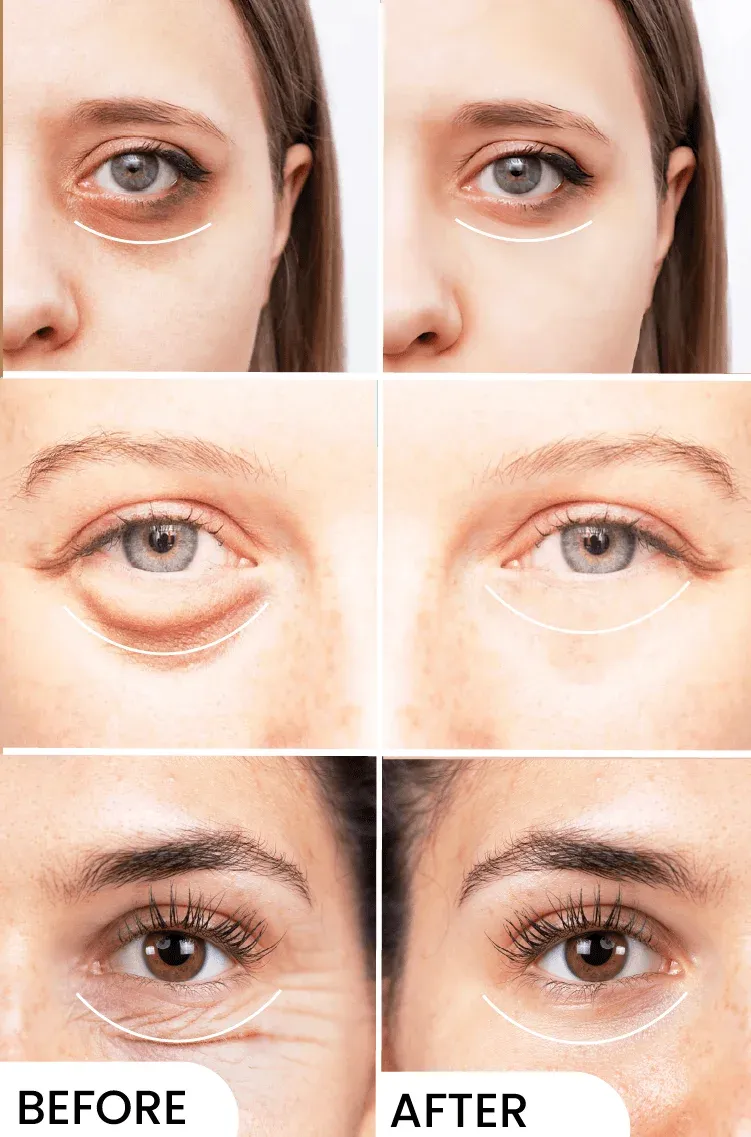 Eyelight Pack of 3 - Eliminates Dark Circles - Image 5